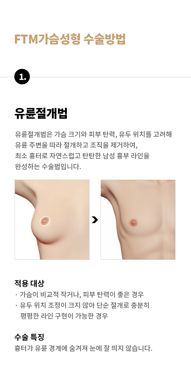 트랜스젠더 가슴성형